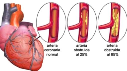 IMA1.arterias del miocardio